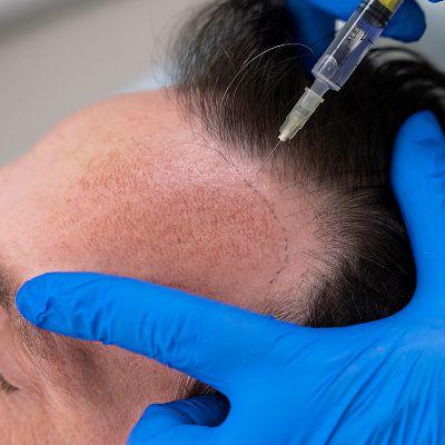 How Many PRP Sessions Do You Really Need for Hair Loss Treatment?
