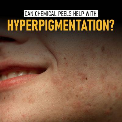 Can Chemical Peels Help with Hyperpigmentation?